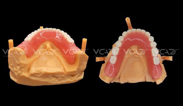 Case study: Lower Denture - Walter Sun
