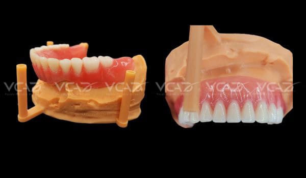 Upper and Lower Denture - Walter Sun