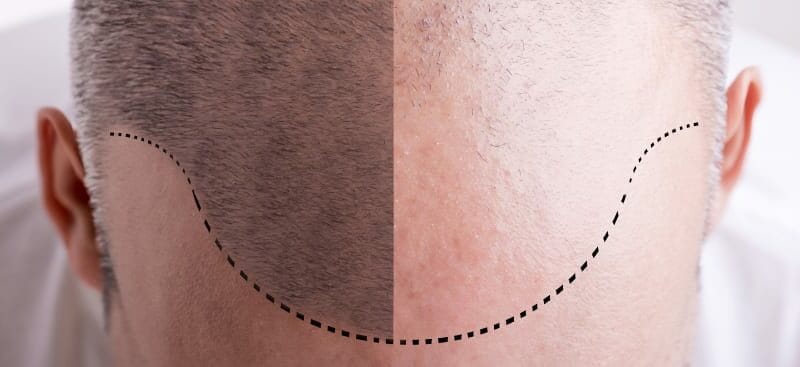 Hair Loss Before and After iStock 000070495709 Small 1
