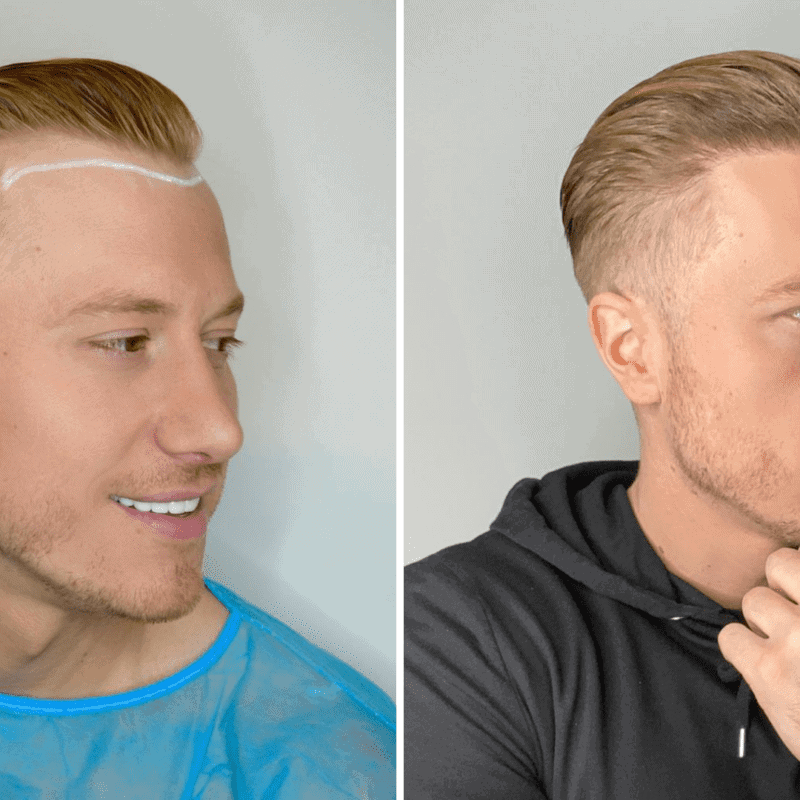 stages of hair transplant week by week
