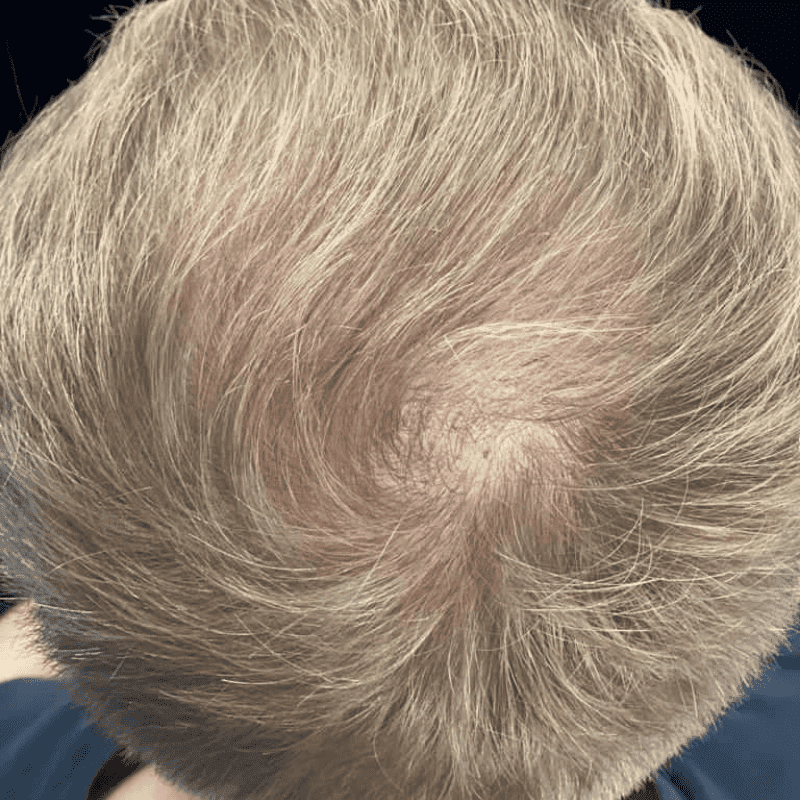 KSL hair transplant