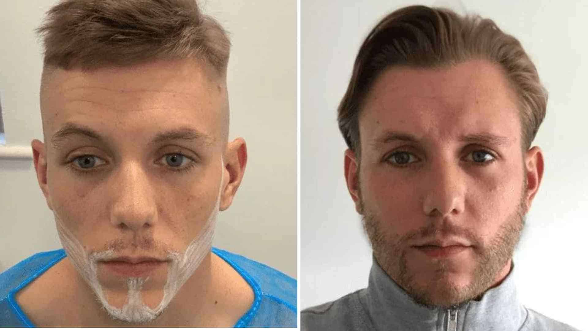 beard hair transplant before and after 1