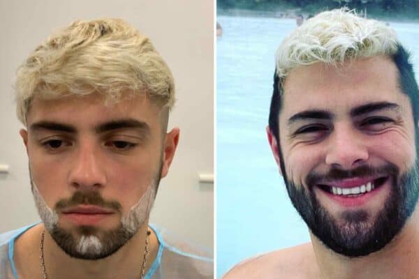 beard transplant stages