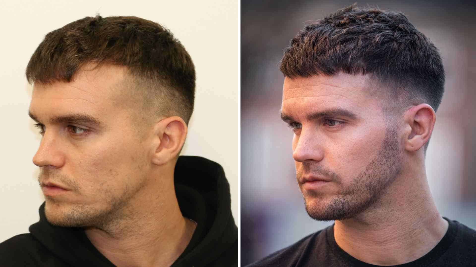 how much does a beard transplant cost
