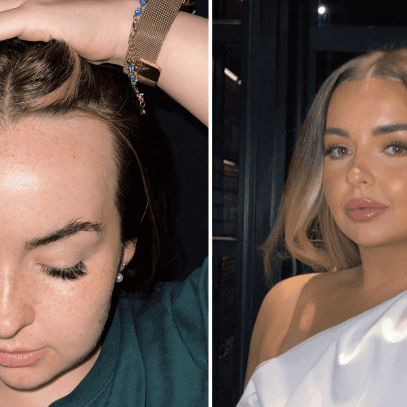 can a hair transplant help with female pattern baldness