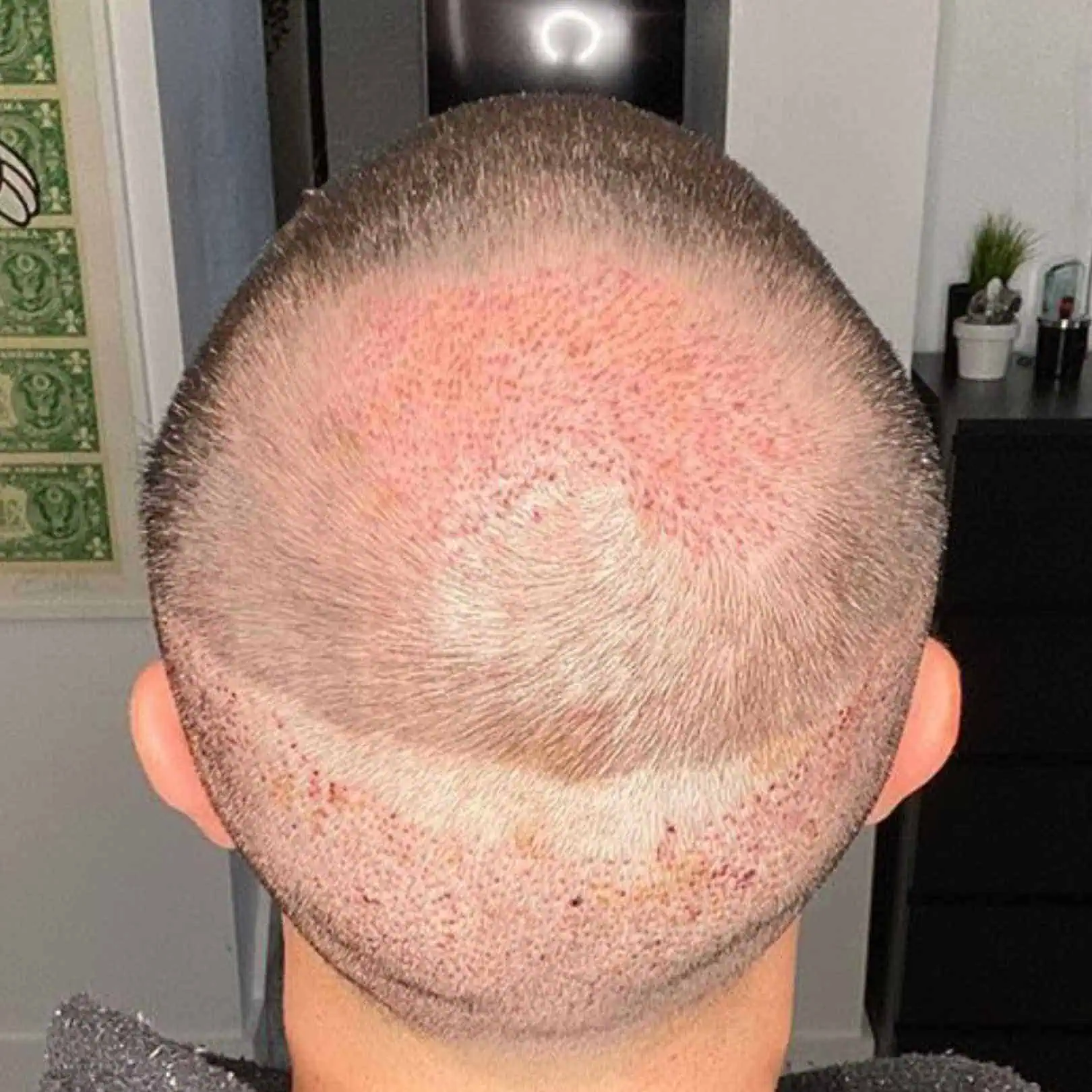 Can a Hair Transplant Help With Scar Repair?