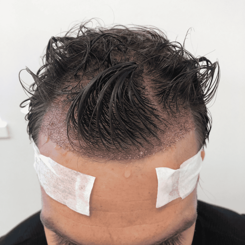 a man on a hair transplant recovery process