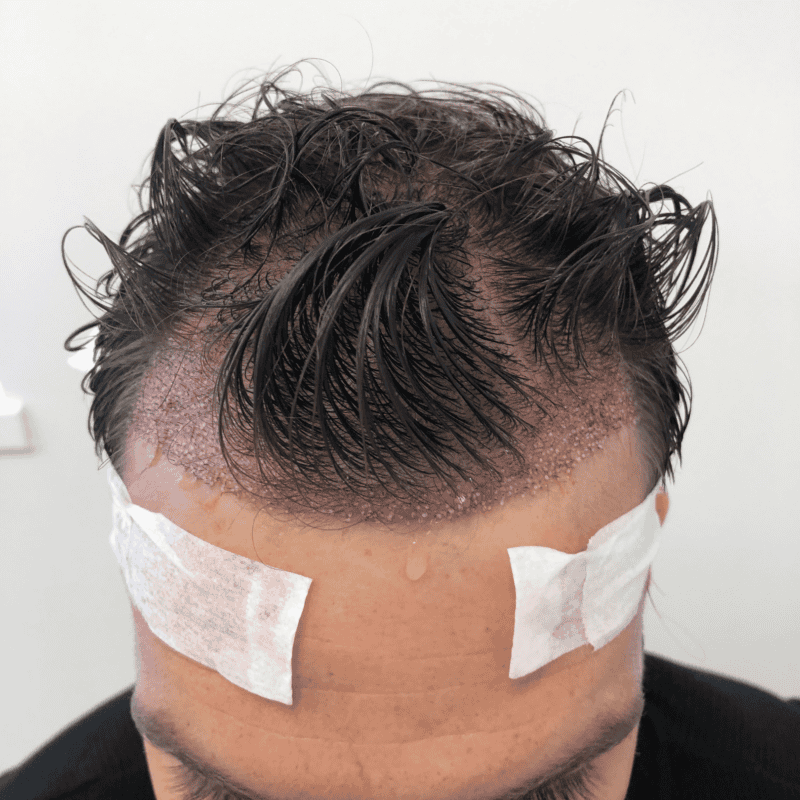 a man on a hair transplant recovery process