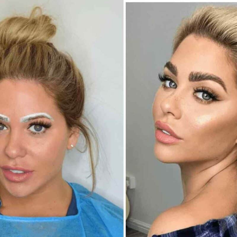 eyebrow transplant cost