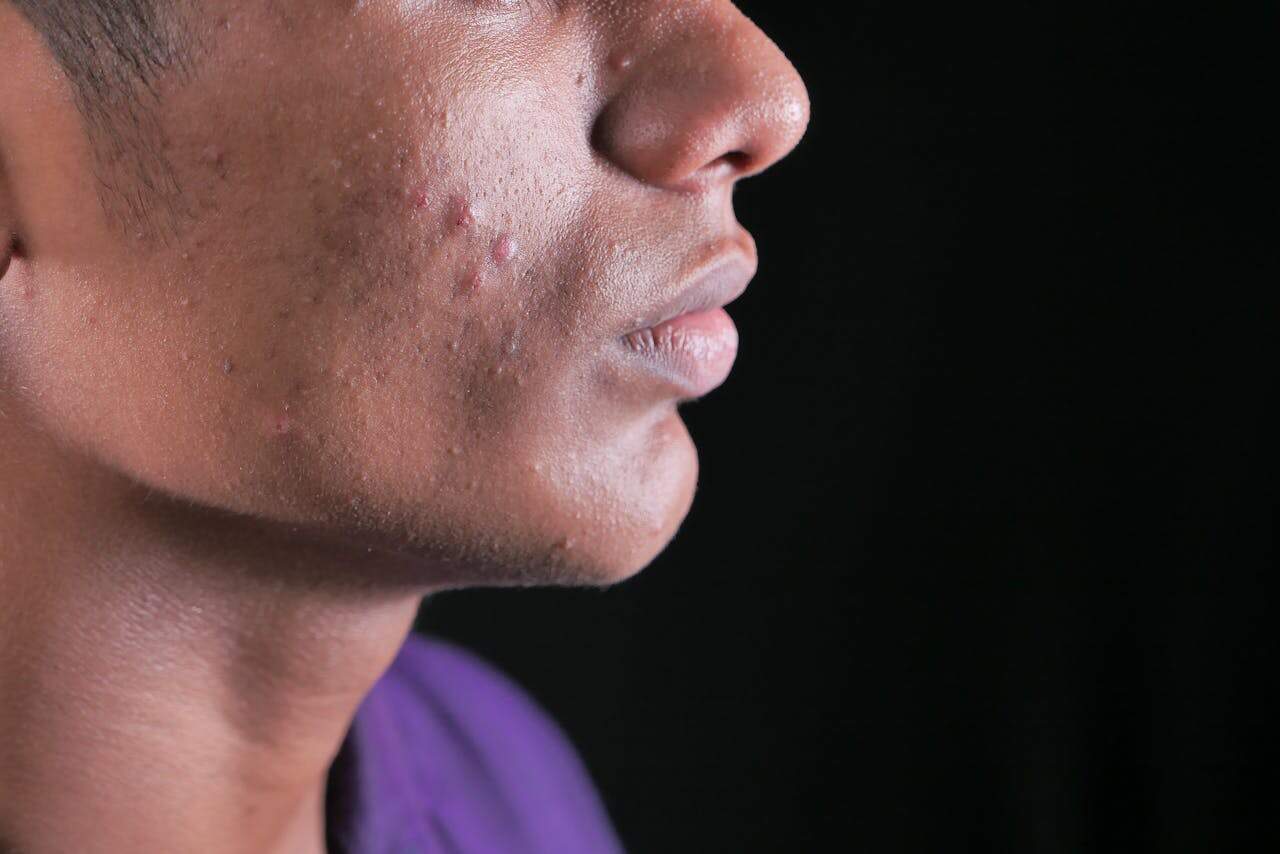 Thinning Sideburns: Causes and Treatments