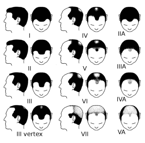 Receding Hairline Stages The Seven Stages of Baldness
