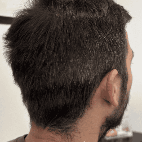 PRP after