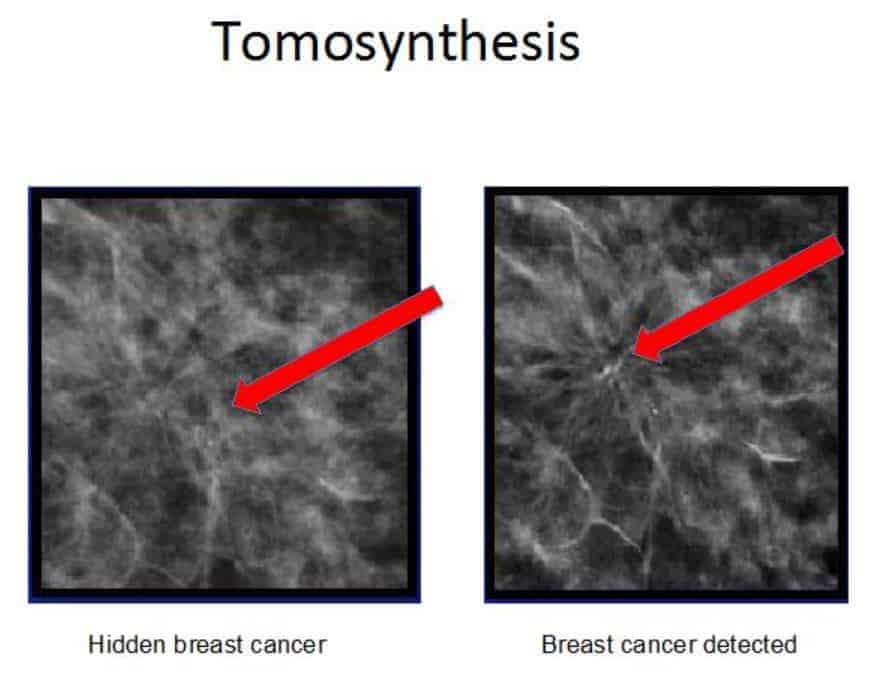 Tomosynthesis (3D Mammography)