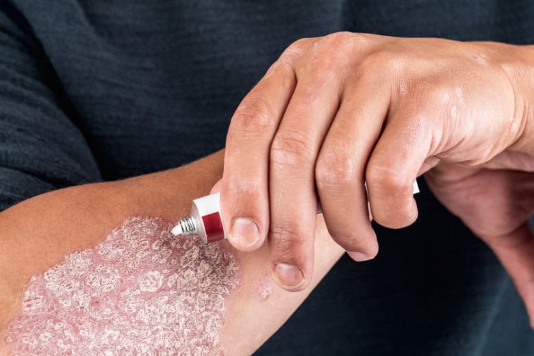 Man with psoriasis using a topical cream