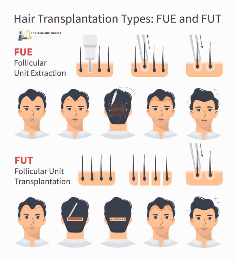 Diagram comparing FUT vs. FUE methods for hair restoration