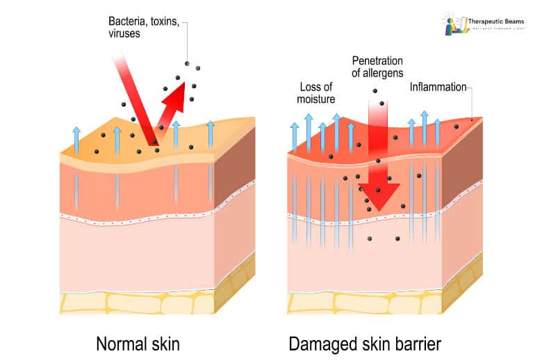 Diagram comparing differences between normal skin with eczema skin