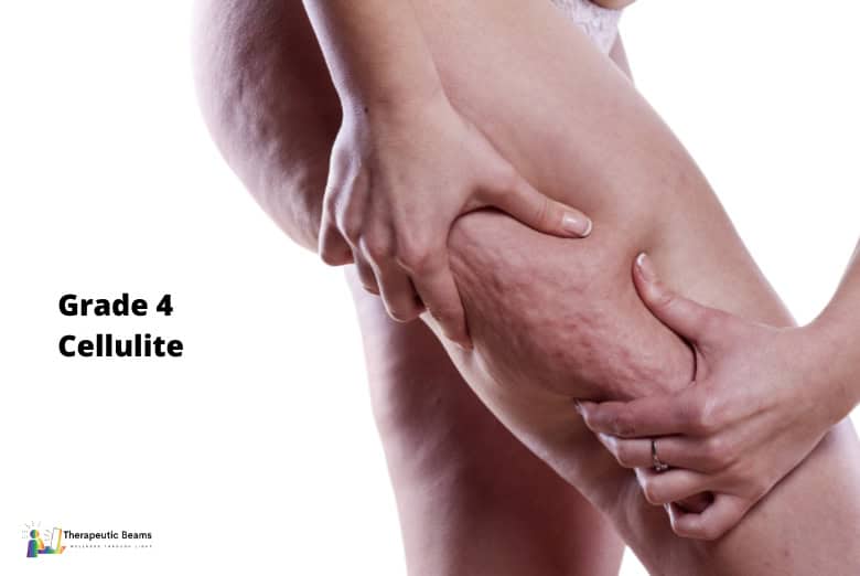 Close-up of severe cellulite on thigh