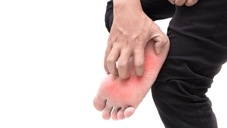 Burning Feet Syndrom - Brennende Füße