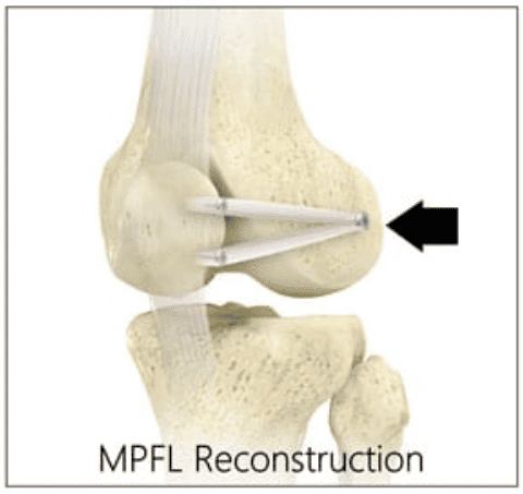 healing a dislocated knee