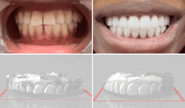 PFM Bridge and Emax Veneers of Dr.Bolade Ogunrinde