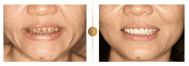 Clinical smile outcome
