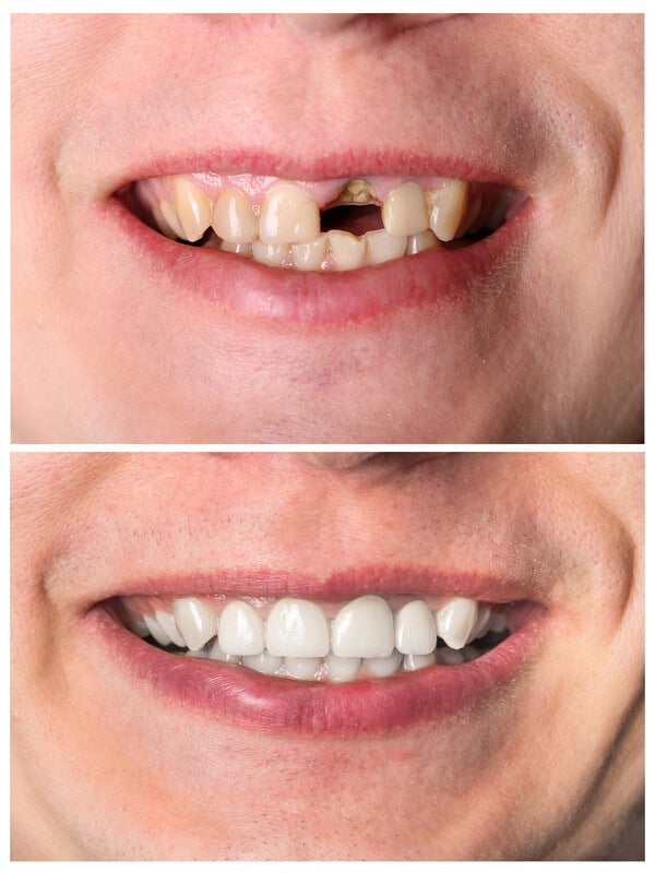 Broken or Chipped Teeth