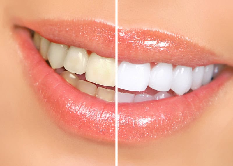 Fresno Teeth Whitening