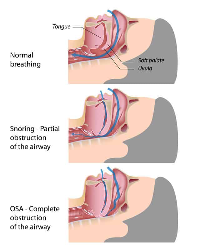 Sleep Apnea