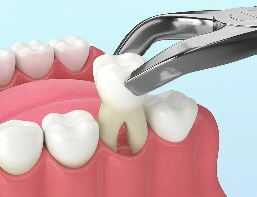 emergency tooth extraction