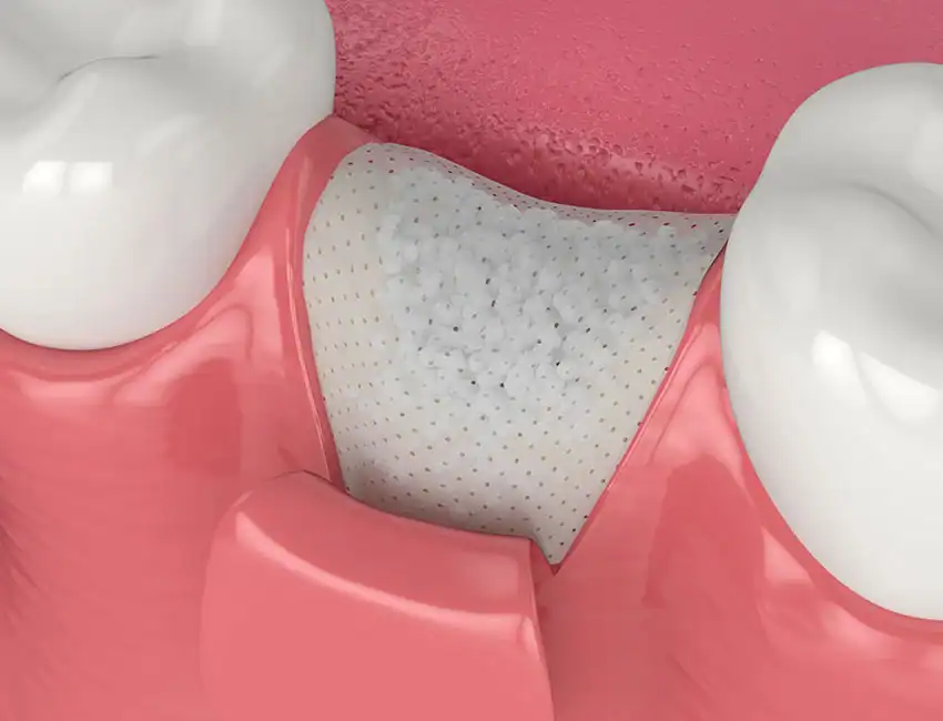 bone graft after tooth extraction in Agoura Hills
