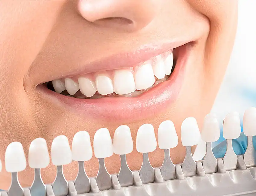 can you whiten veneers