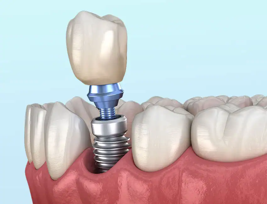permanent dental implants