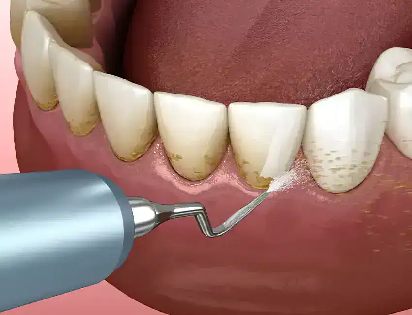 deep teeth cleaning in Los Angeles