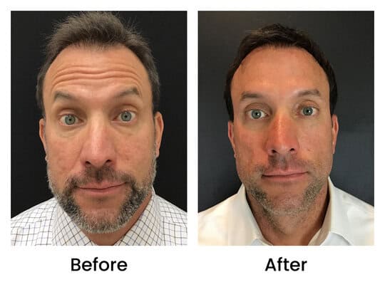 Botox