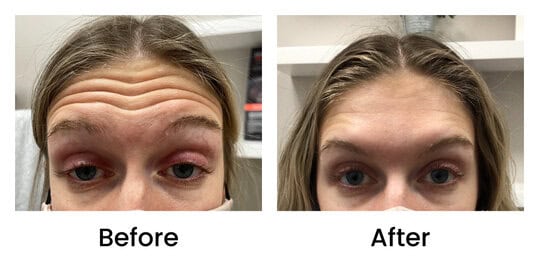 Botox