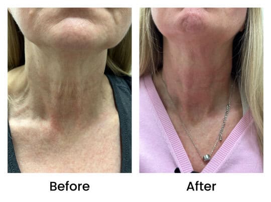 Botox