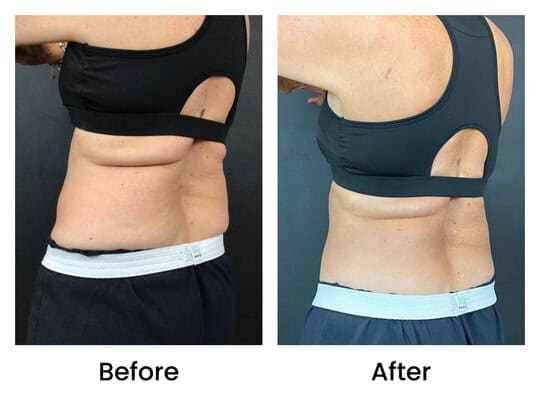 Coolsculpting