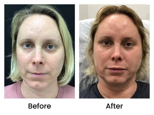 dermalfiller