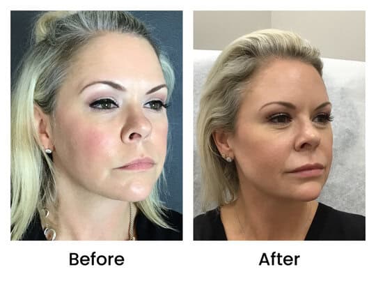 dermalfiller