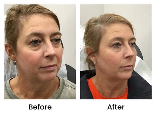 dermalfiller