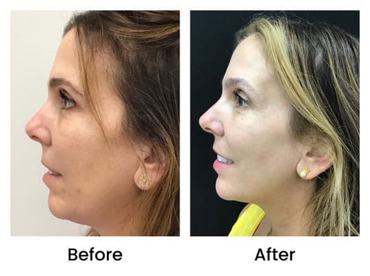 hydrafacial