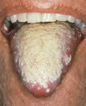 son candidiasis candidiasis causadas por alimentos