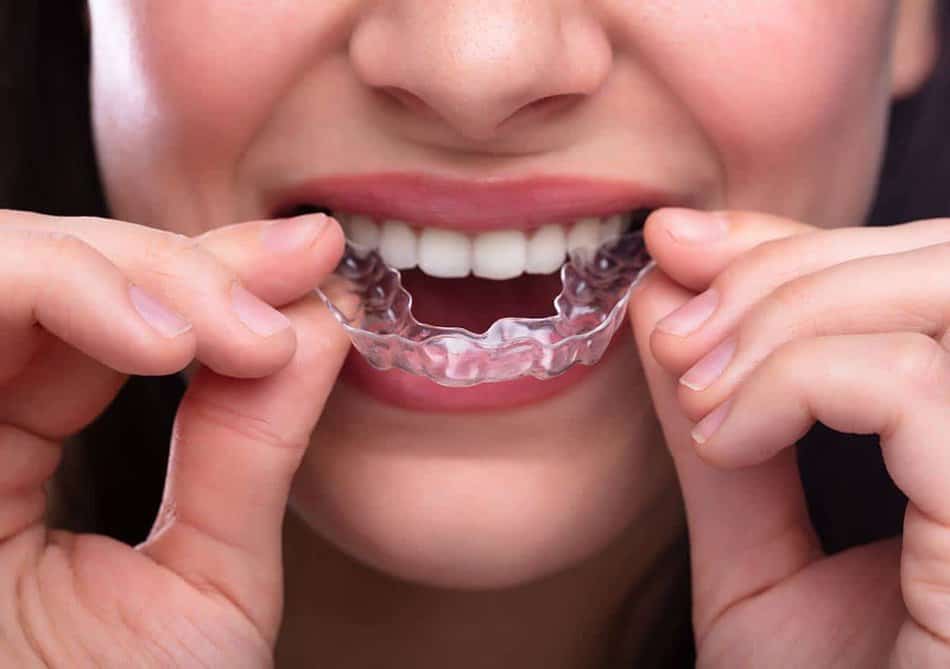 Invisalign Providers Near Me Saint Albans thumbnail