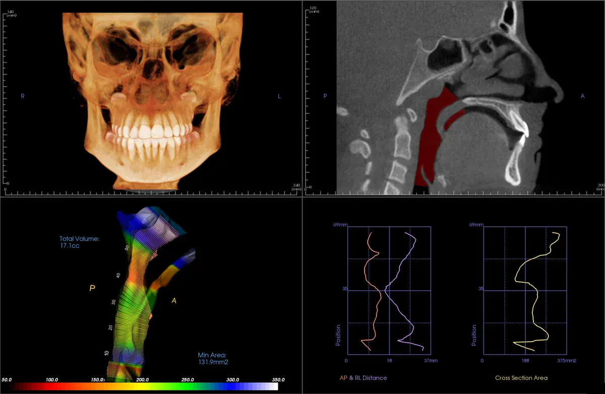 3D CBCT airway evaluation scan