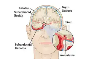 subaraknoid kanama nedir
