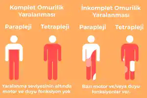 omurilik-felci-2048×1358