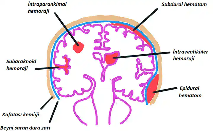 beyin kanaması nasıl oluşur