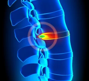thoracic spine surgery in Germany - GermanyHealth