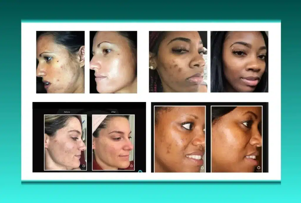 Acne & Acne Scars Chemical Peel at 5-Star Spa Rockville MD 1 Acne & Acne Scars Chemical Peel at 5-Star Spa Rockville MD