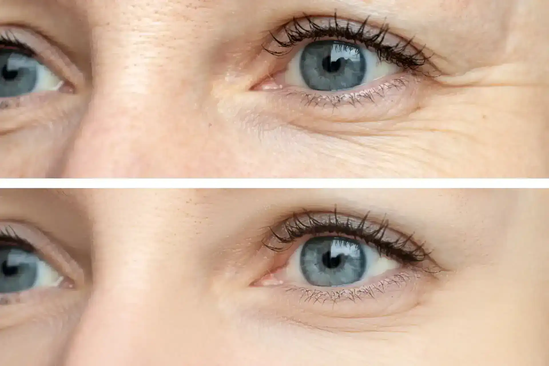juvederm image 1